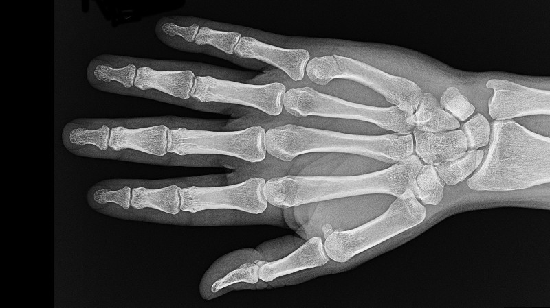 Röntgenaufnahmer einer Hand